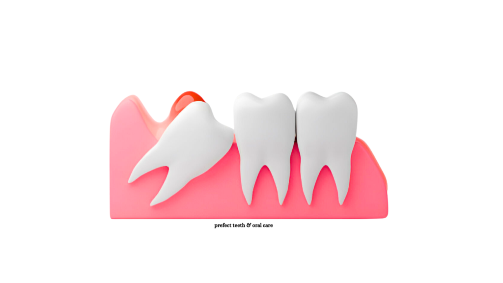 Wisdom tooth abscess