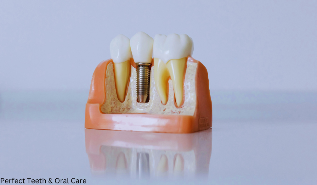 cost of full mouth dental implants