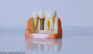 cost of full mouth dental implants